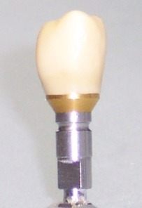 Implantatkrone - Galler Zahntechnik